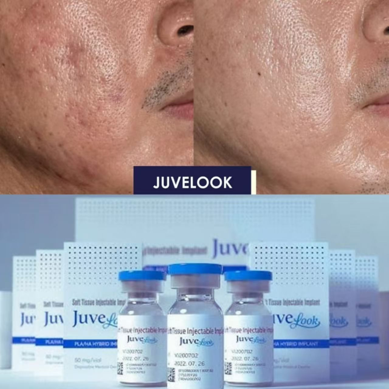 Juvelook 50mg Pdlla Plla + Ha Collagen Stimulator Wrinkle Pouch Filler