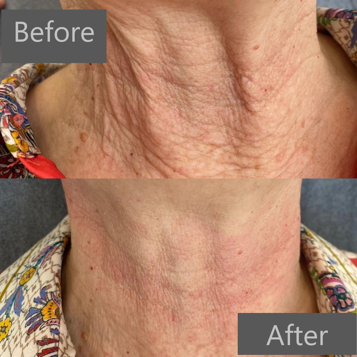 Buy Lenisna 200mg plla+ha 5ml PLLA korea PLLA dermal filler