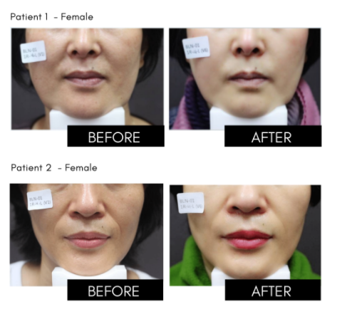 Buy Etrebelle korea PLLA dermal filler Etrebelle
