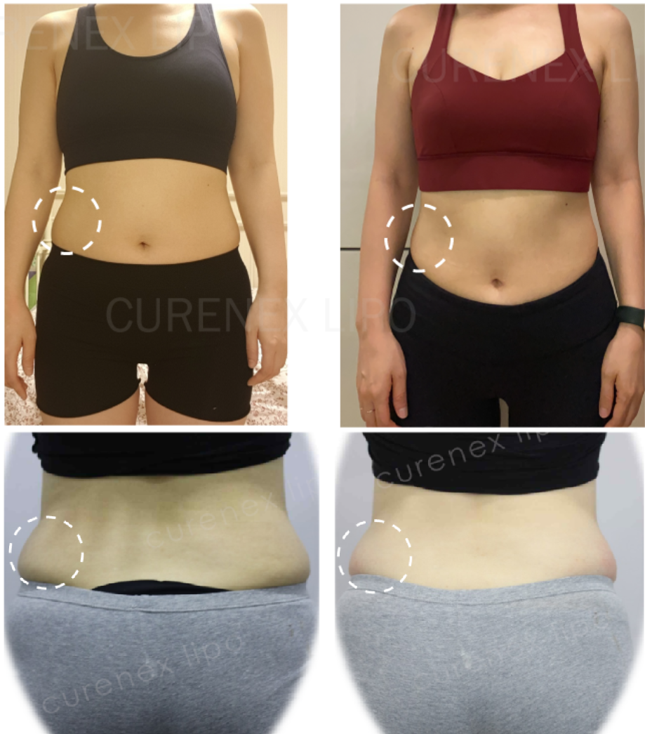 korea top sale Curenex for face double chin fat solution
